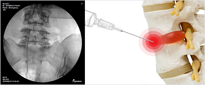 C-arm 신경블럭주사